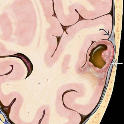 U sao bào đa hình thái tế bào vàng (Pleomorphic Xanthoastrocytoma - PXA)