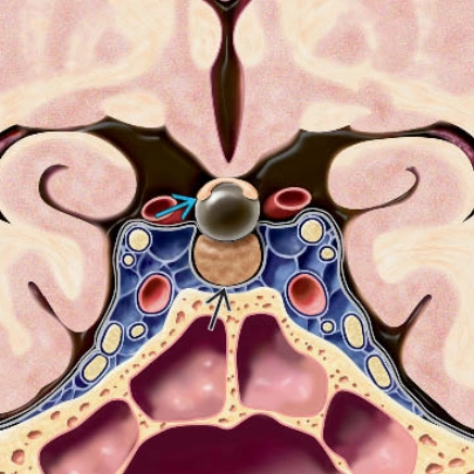 U nang khe Rathke (Rathke cleft cysts)