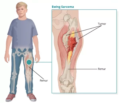 Sarcoma Ewing (Ewing sarcoma)