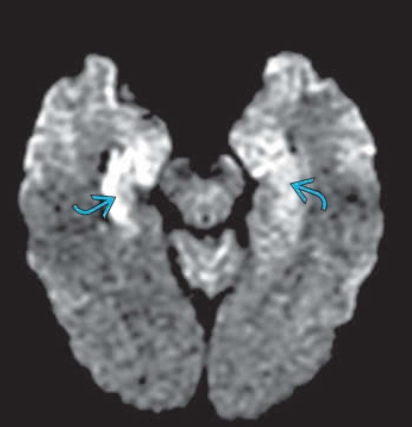 Viêm não do Human herpesvirus 6 (HHV-6) - (HHV-6 Encephalitis/Encephalopathy)