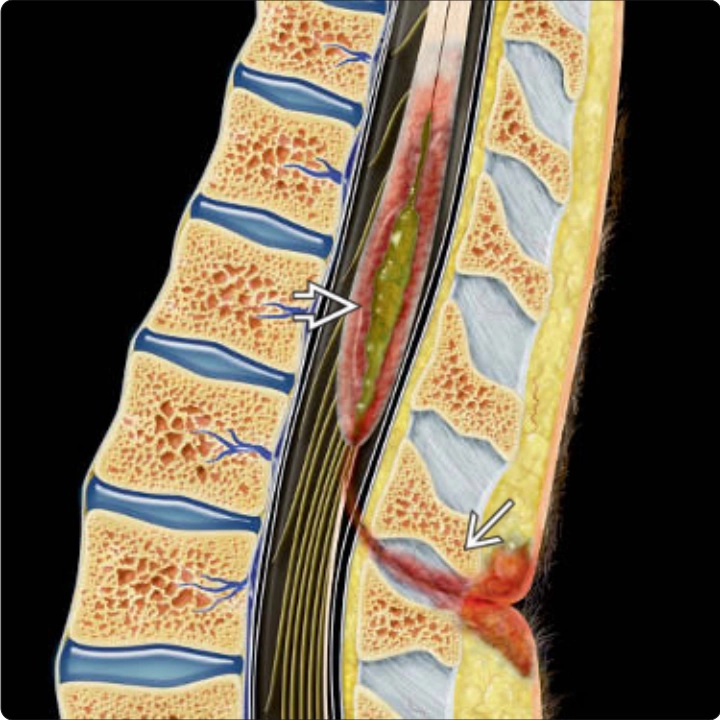 Nhiễm trùng cột sống (Spinal Infection)