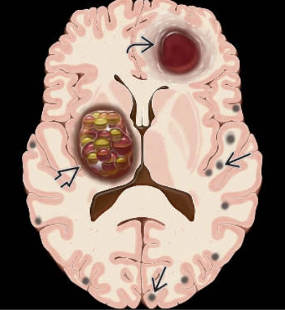 Dị dạng thể hang ở não (Cerebral Cavernous Venous Malformations)