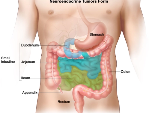 U thần kinh nội tiết ruột non (Small bowel neuroendocrine tumor - SBNET)