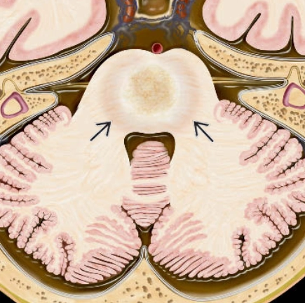 Hội chứng hùy myelin do thẩm thấu (Osmotic Demyelination Syndrome - ODS) 