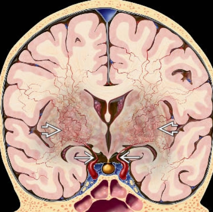 Bệnh Moyamoya (Moyamoya disease)