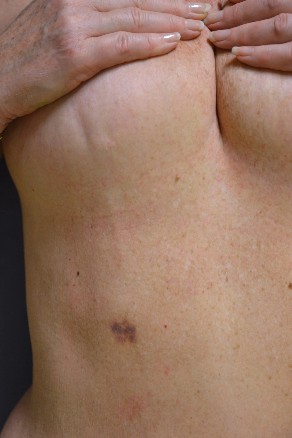 Bệnh Mondor (Mondor disease)