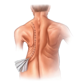 Phẫu thuật tạo hình lồng ngực (Thoracoplasty)