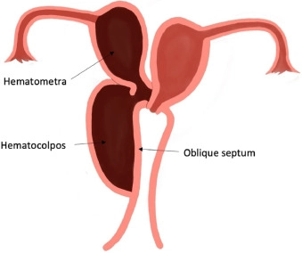Hội chứng HWW/OHVIRA (Herlyn-Werner-Wunderlich syndrome)