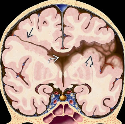 Nứt não (Schizencephaly)