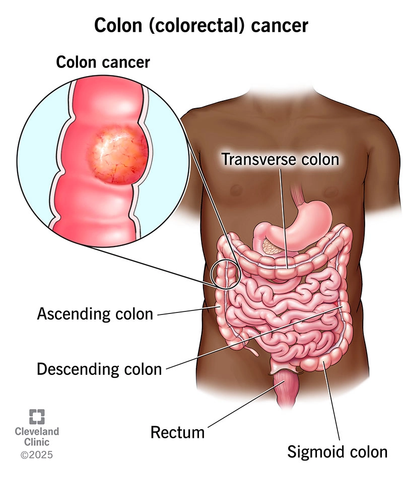 Phân loại giai đoạn ung thư đại trực tràng (Colorectal cancer (staging))