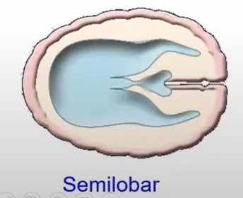 Não trước không phân chia thể bán phần thùy (Semilobar holoprosencephaly)