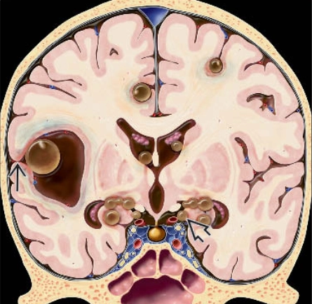 Bệnh ấu trùng sán lợn ở hệ thần kinh (Neurocysticercosis) 