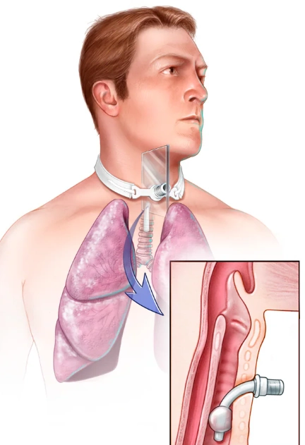 Ống mở khí quản (Tracheostomy Tubes)