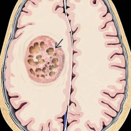 U sao bào dạng nguyên bào, có thay đổi MN1 (Astroblastoma, MN1-altered )
