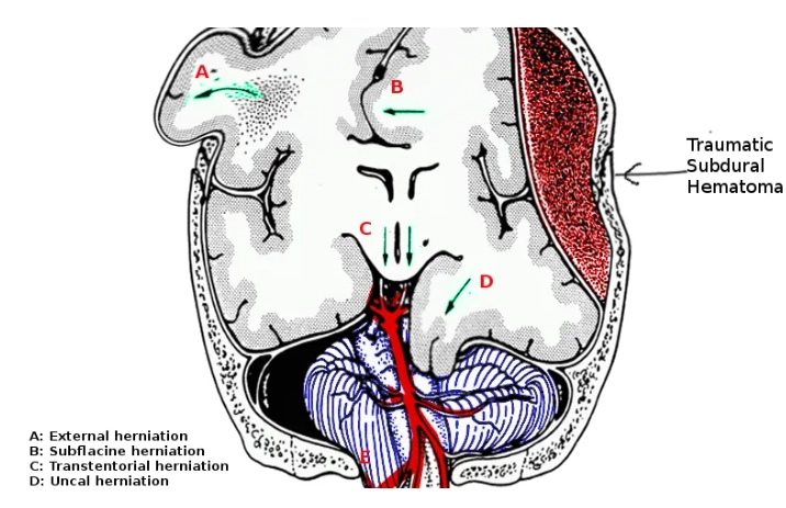 Thoát vị dưới liềm (Subfalcine Herniation - SFH)