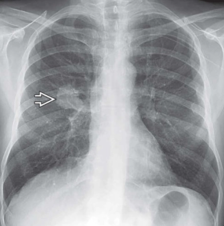 Ghép tế bào gốc tạo máu (Biến chứng ở ngực) - Hematopoietic stem cell transplantation (thoracic complications)