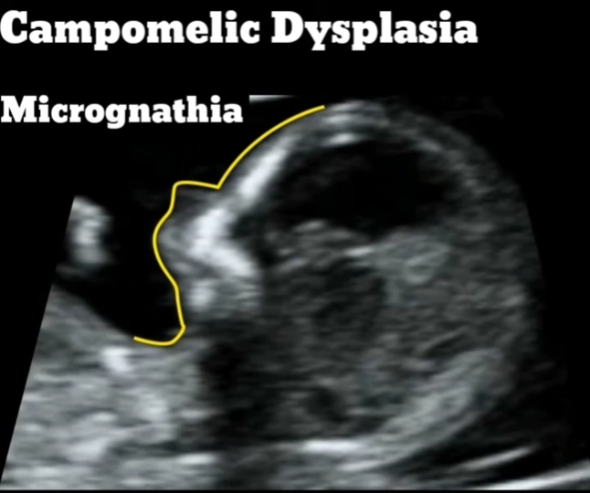 Loạn sản xương cong thai nhi (Campomelic Dysplasia - CD)