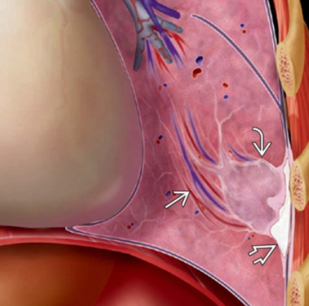 Xẹp phổi tròn (Round atelectasis)