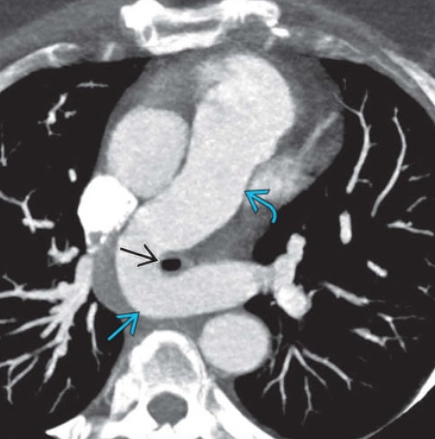 Động mạch phổi trái lạc chỗ (Aberrant left pulmonary artery)/Vòng động mạch phổi (Pulmonary artery sling - PAS)