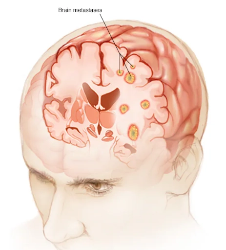 Di căn nhu mô não (Parenchymal metastases)