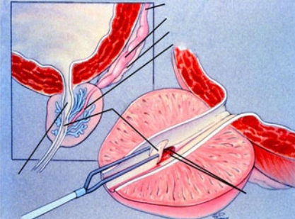 Nang ống phóng tinh (Ejaculatory duct cyst)