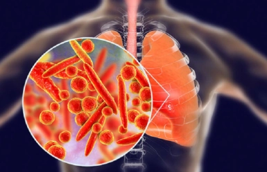 Viêm phổi Legionella (Legionella pneumonia)