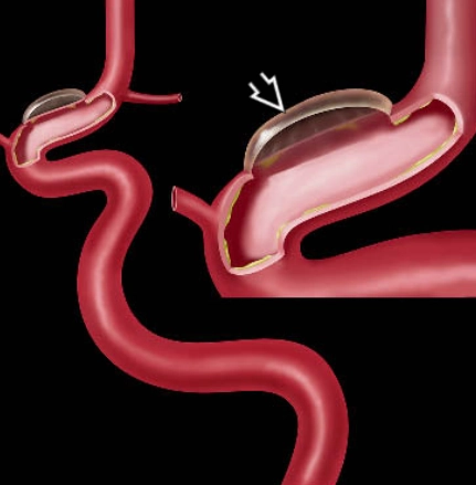 Phình mạch dạng mụn nước (Blood Blister-like Aneurysm- BBA)