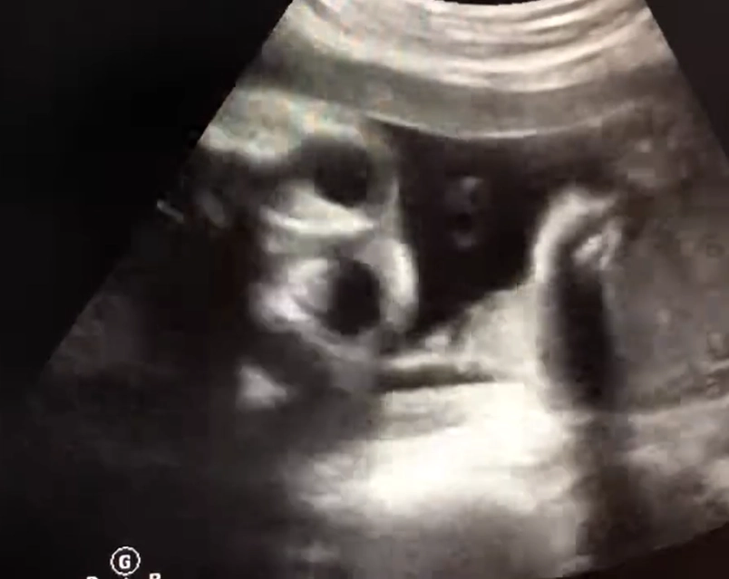 Hai mắt gần nhau ở thai (Hypotelorism )