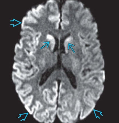 Bệnh Creutzfeldt-Jakob (Creutzfeldt-Jakob disease - CJD)