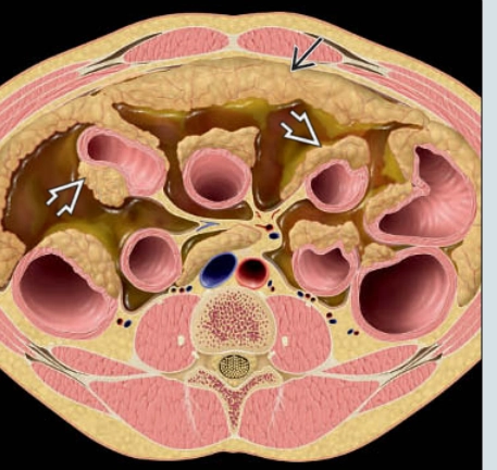 U di căn phúc mạc (Peritoneal Metastases)