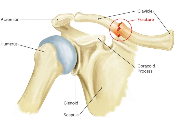 Gãy xương đòn (Clavicular fractures)