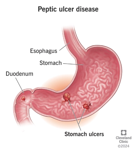 Thủng do loét dạ dày-tá tràng (Perforated peptic ulcer)