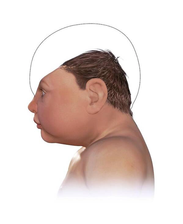 Tật đầu nhỏ thai nhi (Microcephaly)