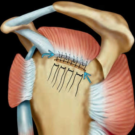 Chóp xoay sau phẫu thuật (Rotator cuff repair)