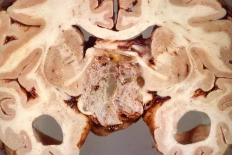U sọ hầu dạng Adamantinoma (Adamantinomatous Craniopharyngioma)