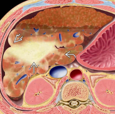 Xơ gan hợp lưu (Confluent hepatic fibrosis)