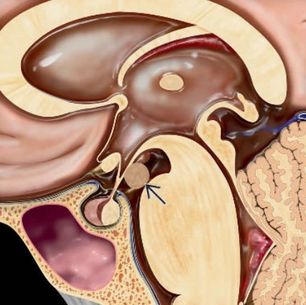 U mô thừa vùng dưới đồi (Hypothalamic hamartomas)