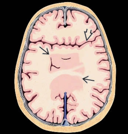 Syntelencephaly / Biến thể Dính liền Liên bán cầu Giữa (MIHV)