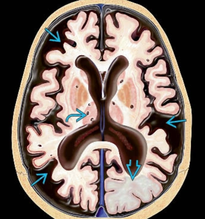 Sa sút trí tuệ do mạch máu (Vascular dementia)