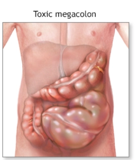 Phình đại tràng nhiễm độc (Toxic megacolon)