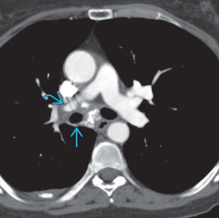 Viêm trung thất xơ hóa (Fibrosing mediastinitis) 