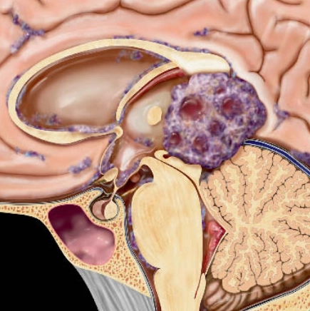 U nguyên bào tuyến tùng (Pineoblastoma)