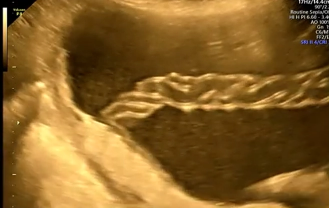 Dây rốn bám mép / Dây rốn bám màng (Marginal Placental Cord Insertion / Velamentous Cord Insertion)