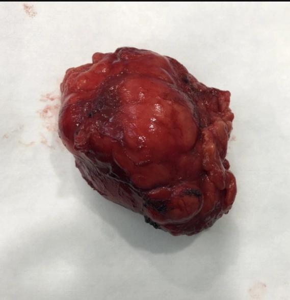 U nguyên bào thần kinh hạch ở trung thất (Ganglioneuroblastoma)