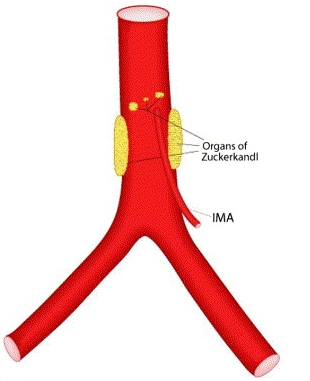 U cận hạch sau phúc mạc (Extra adrenal paraganglioma)