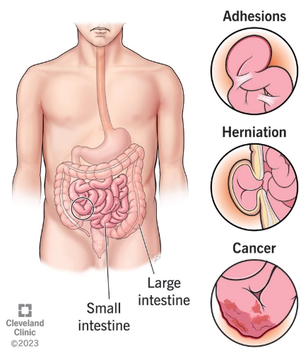 Tắc đại tràng (Large Bowel Obstruction - LBO)