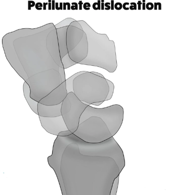 Trật quanh nguyệt (Perilunate dislocation)