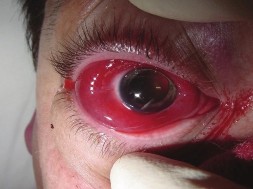 Hội chứng khoang hốc mắt (Orbital compartment syndrome)