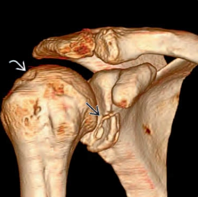 Trật khớp vai ra trước (Anterior shoulder dislocation) 