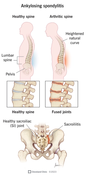 Viêm cột sống dính khớp (Ankylosing spondylitis)
